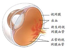 1型糖尿病性视网膜病变