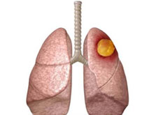阿米巴肺脓肿