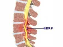 椎管狭窄