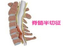 脊髓半切征