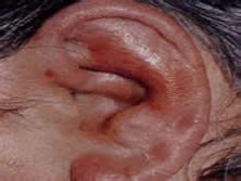 耳廓化脓性软骨膜炎