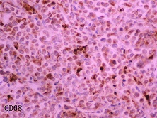 粒细胞肉瘤