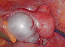 卵巢成熟性畸胎瘤