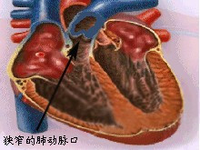 肺动脉口狭窄