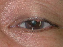 眼睑皮脂腺癌