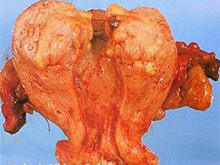子宫内膜间质肉瘤