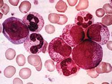 急性髓细胞白血病