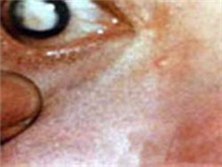 水痘-带状疱疹性葡萄膜炎
