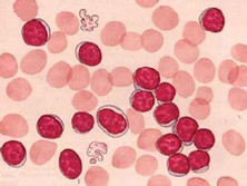 肥大细胞白血病