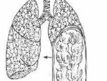 肺疝