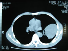 肺部少见的恶性肿瘤