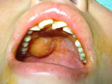口腔恶性肿瘤