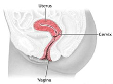 阴道腺癌