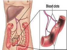 非闭塞性肠系膜血管缺血