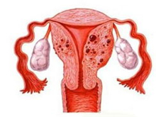 原发性输卵管癌