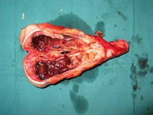腹壁纤维肉瘤