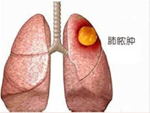 肺脓肿