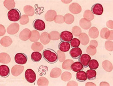 慢性粒单核细胞白血病