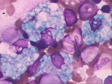 小儿海蓝组织细胞增生症