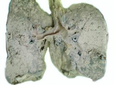肺腺癌