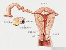 绝经后子宫内膜癌