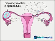 输卵管妊娠流产