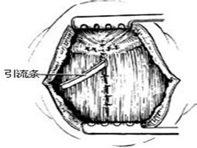 甲状舌囊肿及瘘管