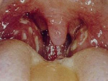 急性舌扁桃体炎