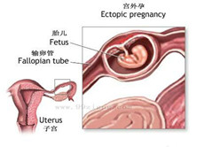 宫外孕