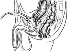 尿道结核