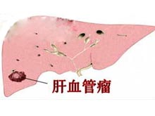 肝血管肉瘤