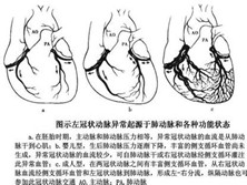 冠状动脉异常起源于肺动脉