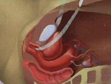 尿道与阴茎结核
