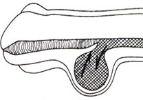 先天性前尿道瓣膜