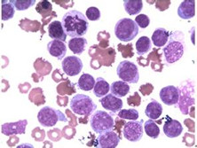 急性粒细胞白血病未分化型