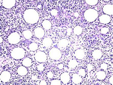 皮下脂膜炎性T细胞淋巴瘤