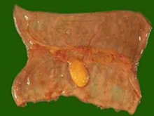 小肠脂肪瘤
