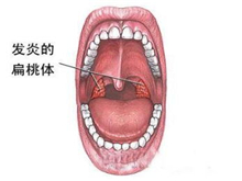 咽扁桃体癌