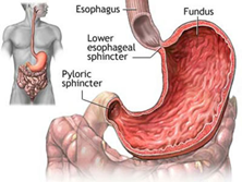 胃十二指肠溃疡瘢痕性幽门梗阻