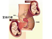 宫颈妊娠