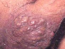 考登病中的多发性毛鞘瘤
