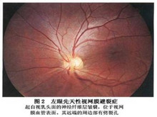 先天性视网膜劈裂症
