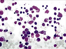 遗传性球形红细胞增多症