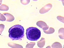 遗传性椭圆形红细胞增多症