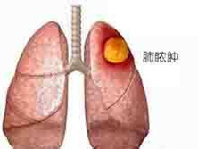 老年肺脓肿