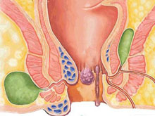 先天性直肠肛管畸形