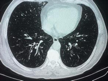 呼吸性细支气管炎间质肺病
