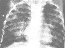 单纯性肺嗜酸粒细胞浸润症