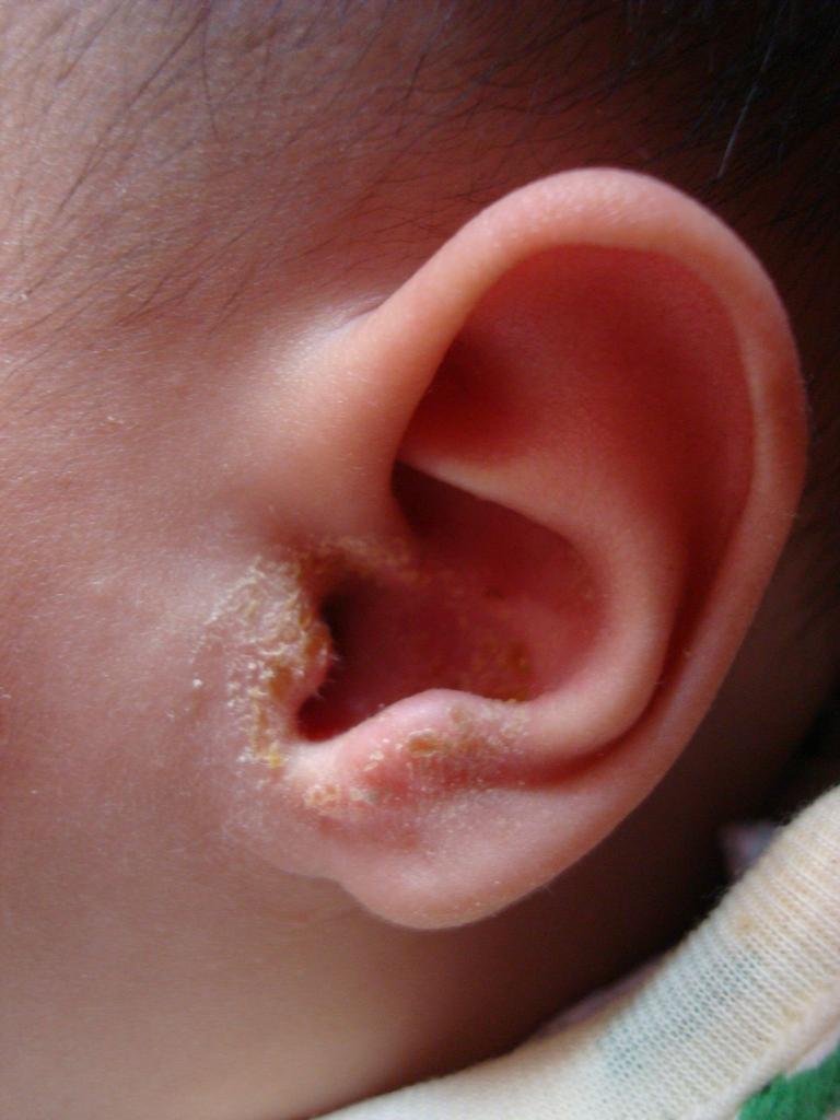 儿童中耳炎