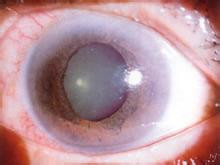 红细胞增多症视网膜病变